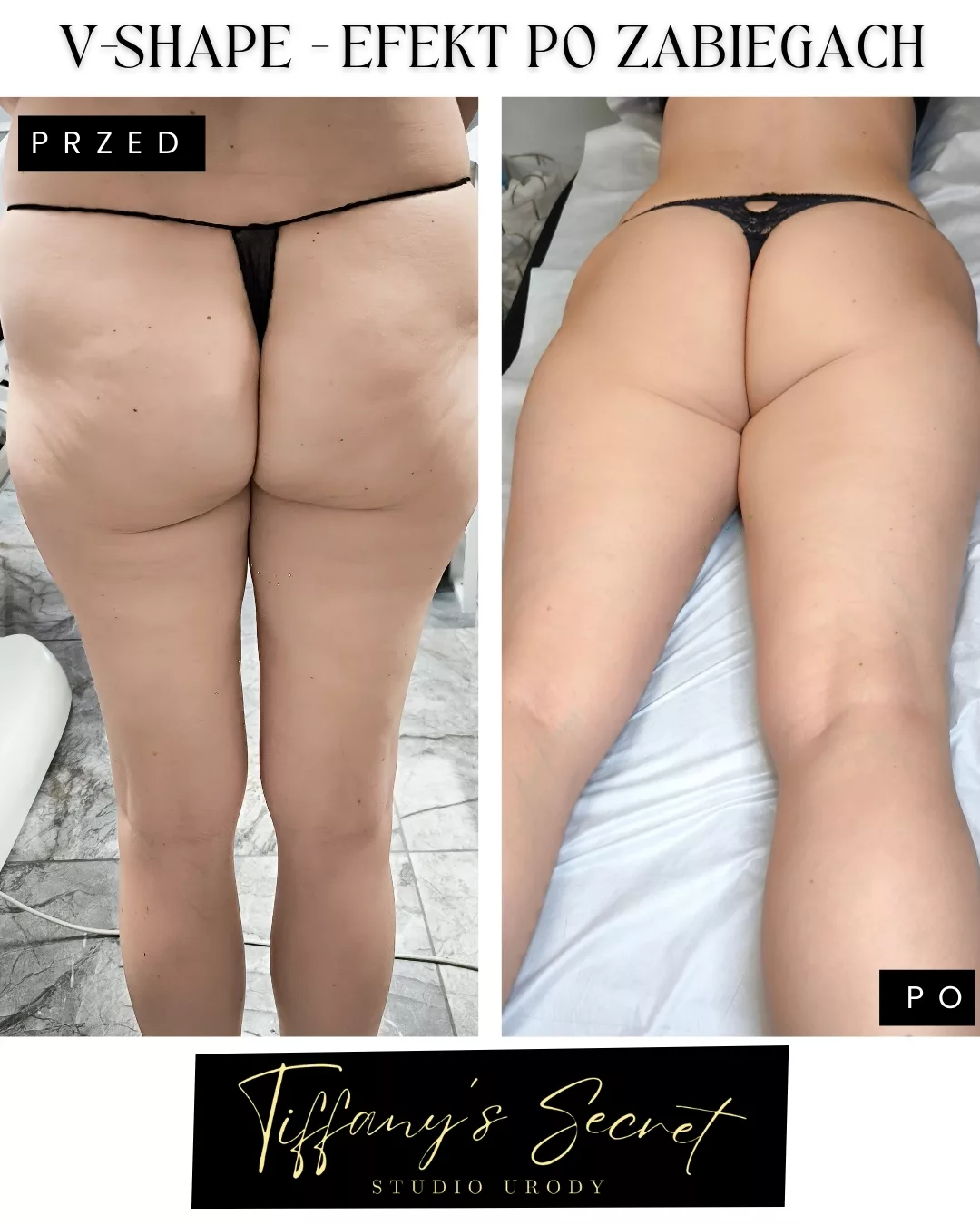 V-Shape – Spektakularne efekty modelowania ciała zabiegami